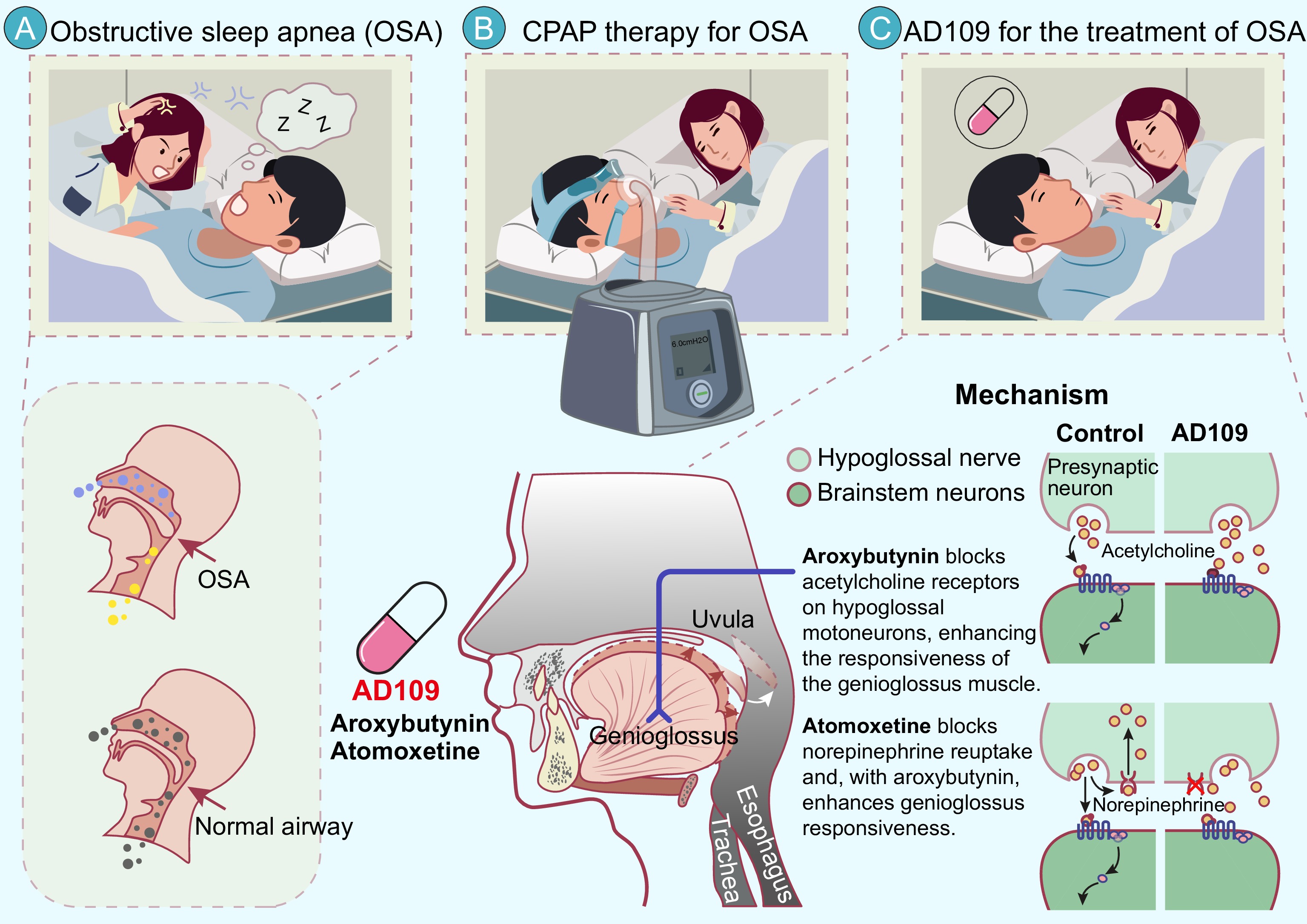 tirzepatide sleep apnea mechanism From sleepless nights to restored days: How AD109 is giving obstructive sleep  apnea patients their lives back