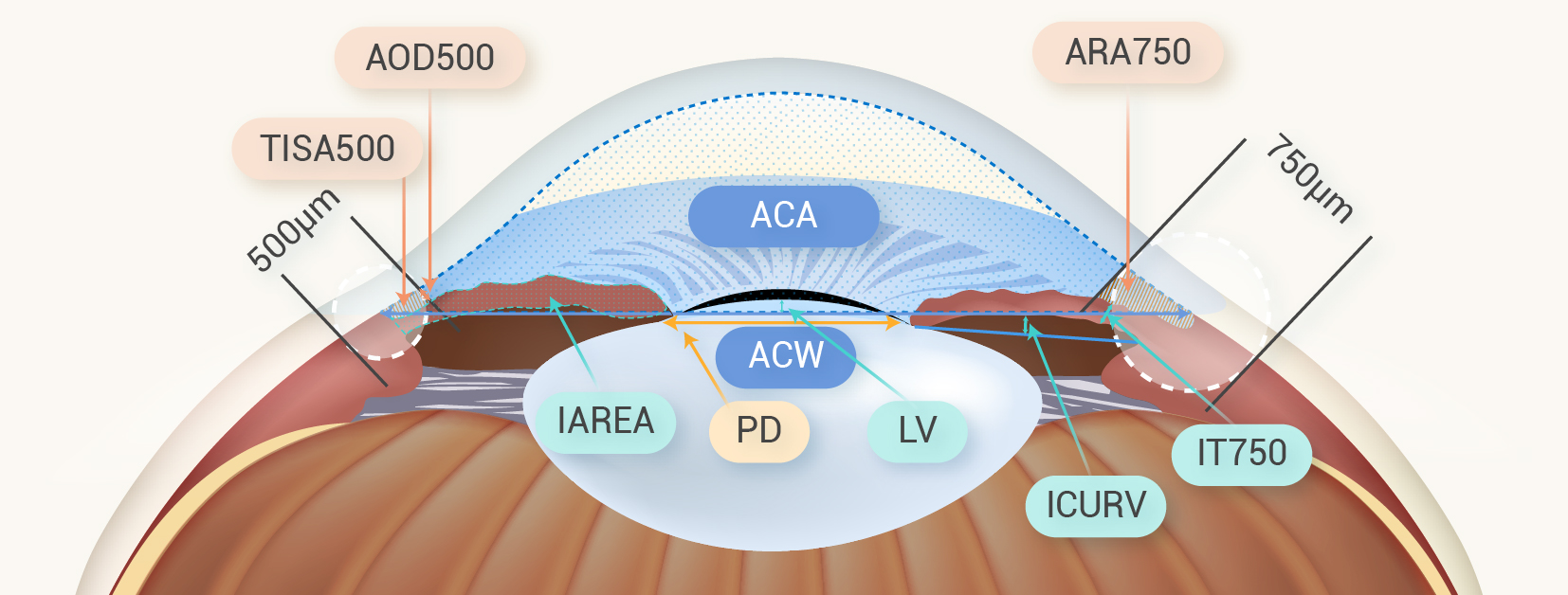 Prediction of angle closure after laser peripheral iridotomy The